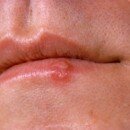COLD SORES