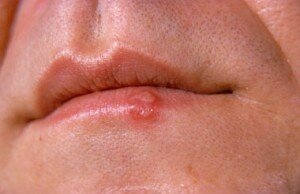 Cold sores