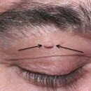 SKIN TAGS