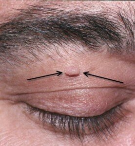 Skin tags