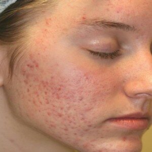 Skin scars
