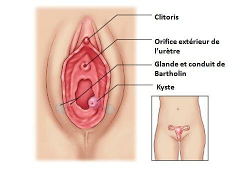 Kyste de Bartholin