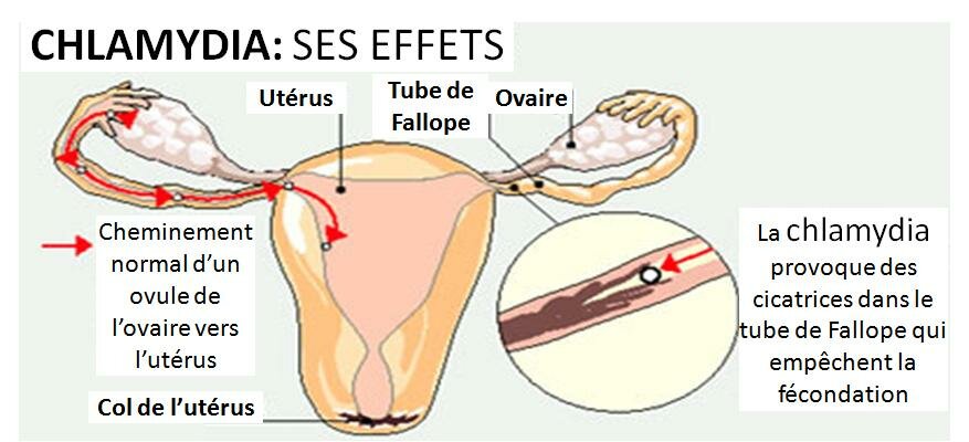 La CHLAMYDIA transmise sexuellement