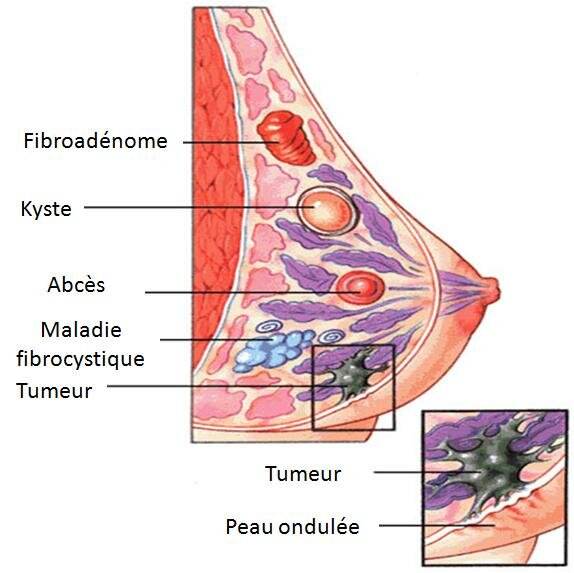 maladies des seins