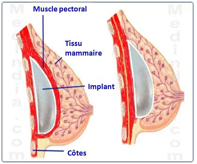 IMPLANTS MAMMAIRES Risques et effets secondaires