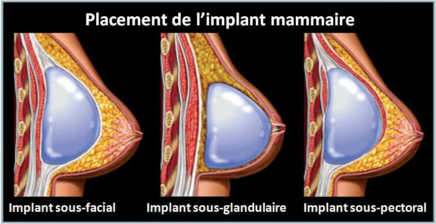 IMPLANTS MAMMAIRES