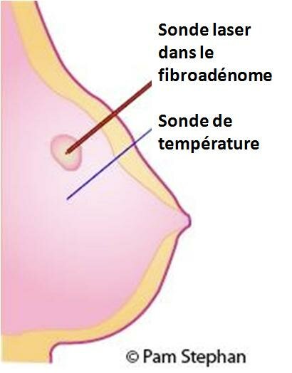 FIBROADENOME du SEIN