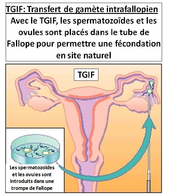 Le transfert de gamète intrafallopien – GIFT