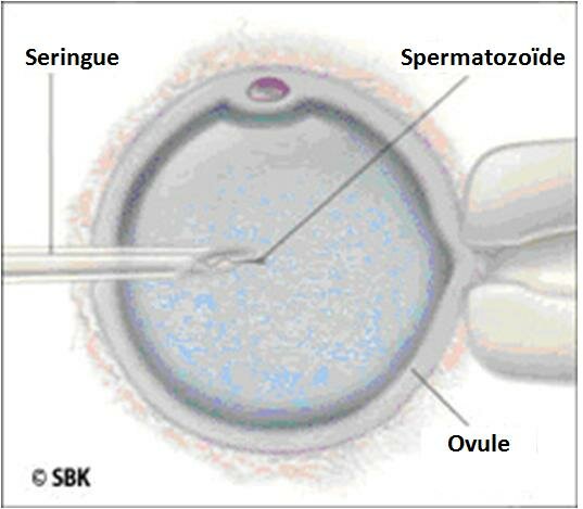 L’injection intracytoplasmique de spermatozoïde – ICSI