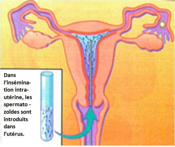 Insémination intra-utérine artificielle (IUI)
