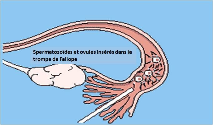 Transfert intrafallopien de gamète (GIFT)