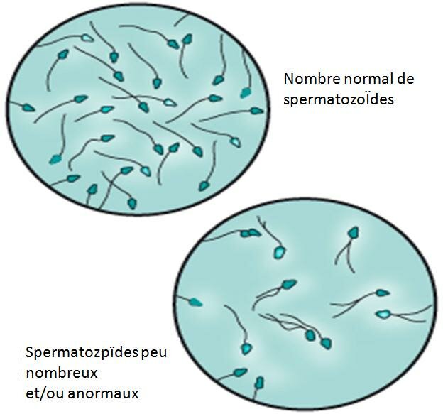 INFERTILITÉ : DIAGNOSTIC