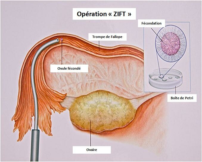 Transfert de zygote intrafallopien (ZIFT)