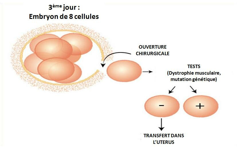 Diagnostic génétique préimplantatoire (DGPI)