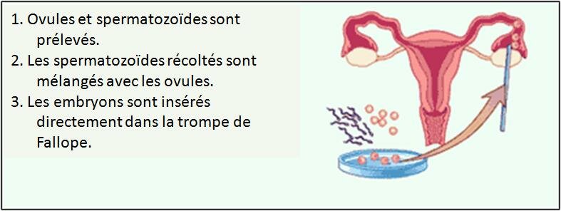 Le transfert de zygote intrafallopien – ZIFT