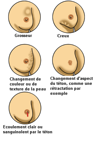 Examen mammaire