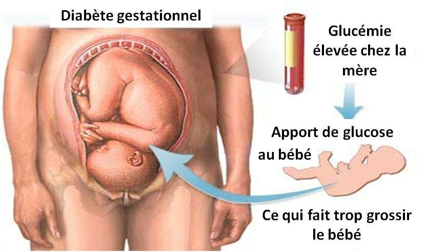 SOPK et grossesse