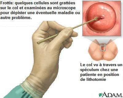 Le frottis