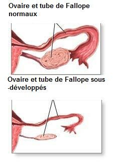 Aménorrhée