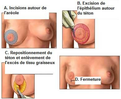 asymetrie des seins