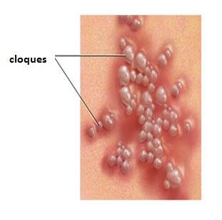 Cloques sur le vagin