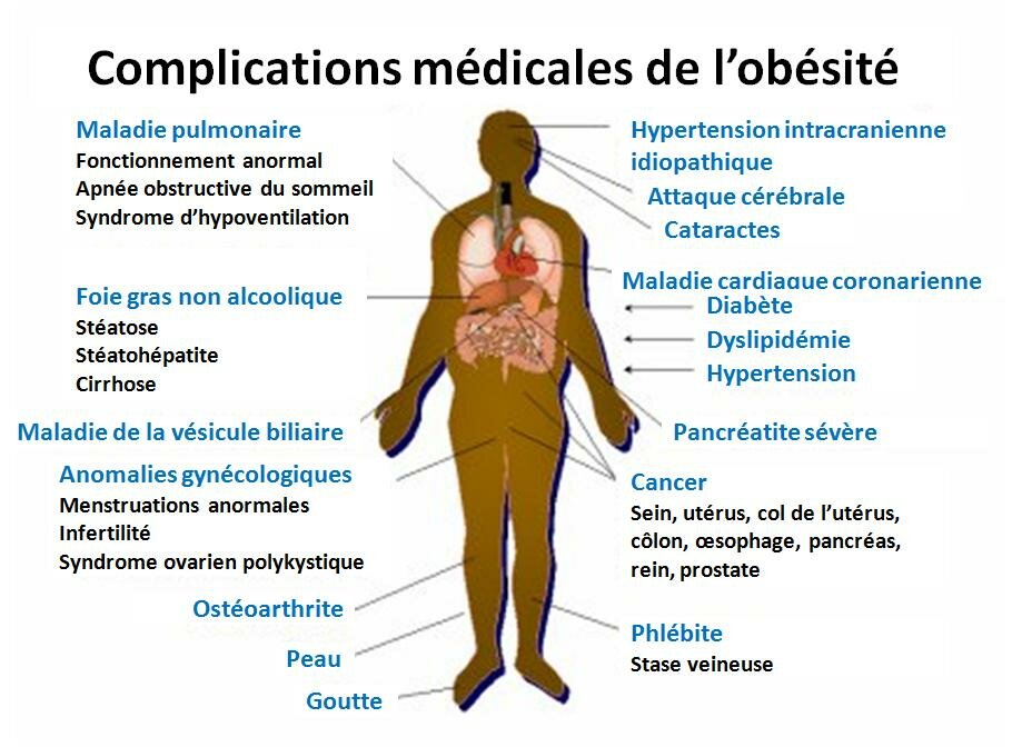 OBÉSITÉ