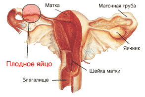 внематочная беременность