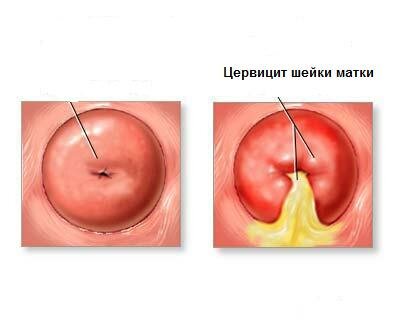 зуд влагалища