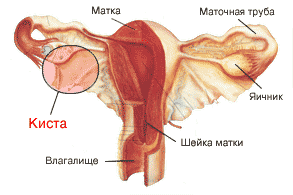 Киста яичника