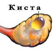 Киста яичника