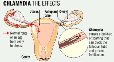 CNLAMYDIA SEXUALLY TRANSMITTED
