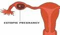 tubal pregnancy
