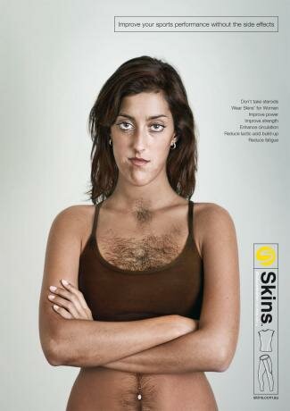 hirsutism