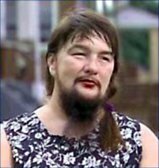 hirsutism
