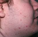 hirsutism