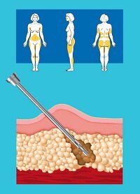 liposuccion
