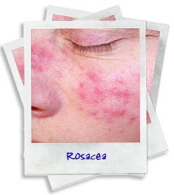 ROSACEA