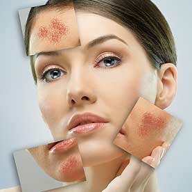 ROSACEA