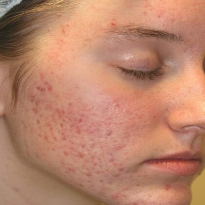 SKIN SCARS